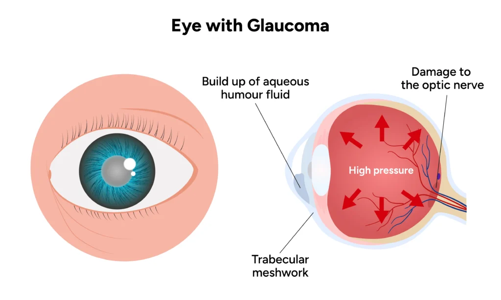 what is the best treatment for glaucoma - oswal eye care