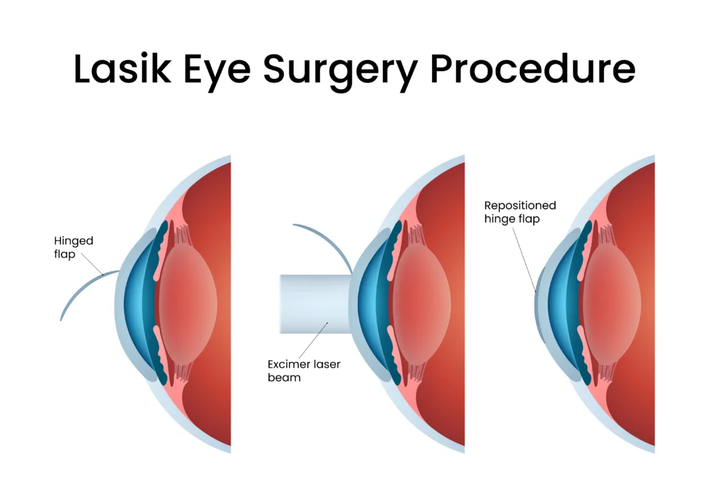 after lasik eye surgery - oswal eye care