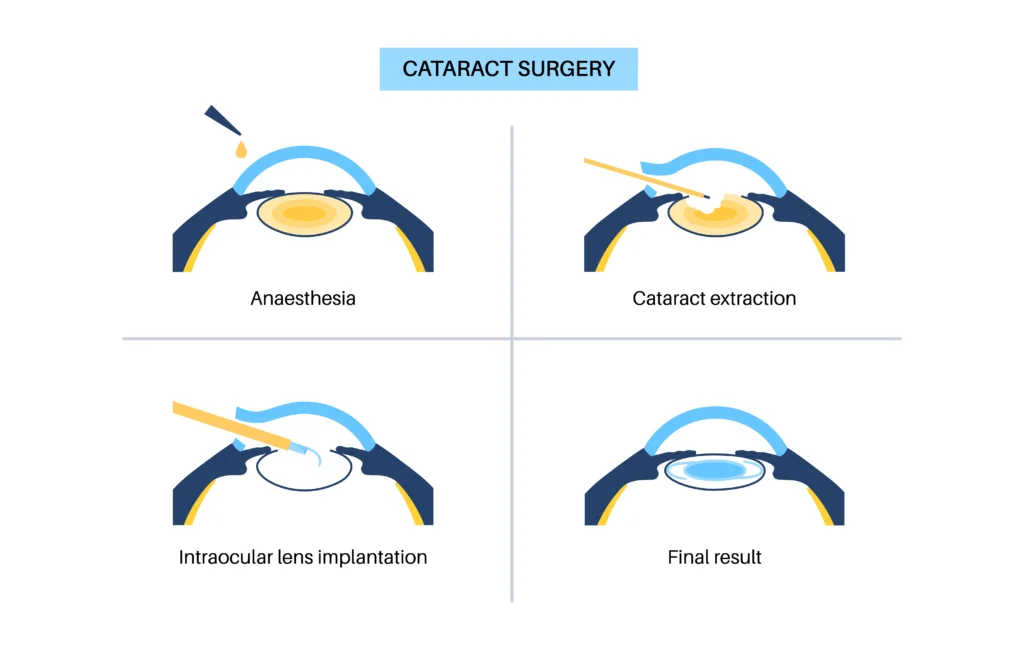 cataract surgery steps - oswal eye care