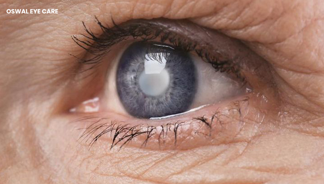cataract eye surgery cost in mumbai - oswal eye care