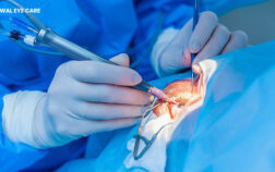 cataract treatment without surgery - oswal eye care