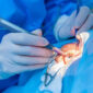 cataract treatment without surgery - oswal eye care