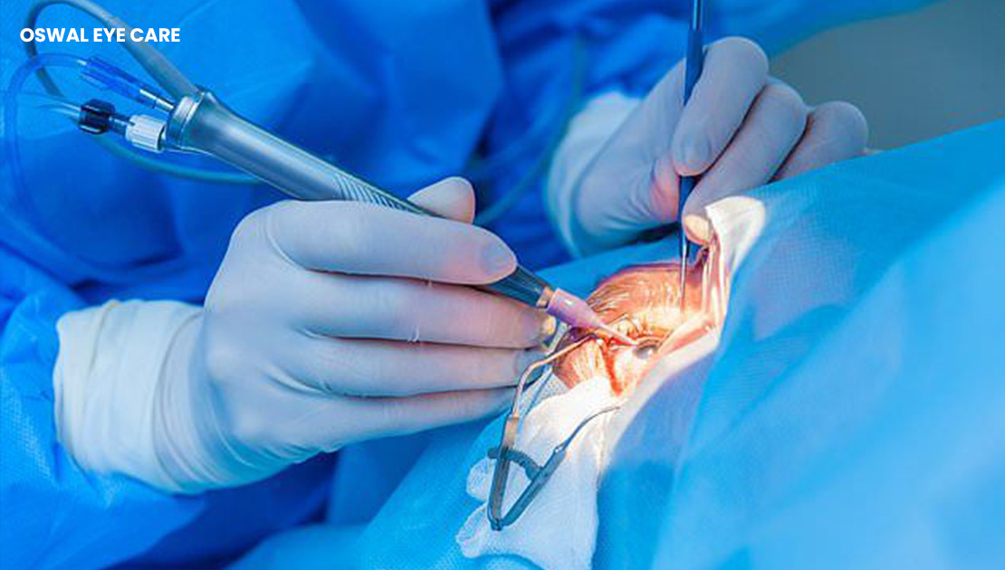 cataract treatment without surgery - oswal eye care